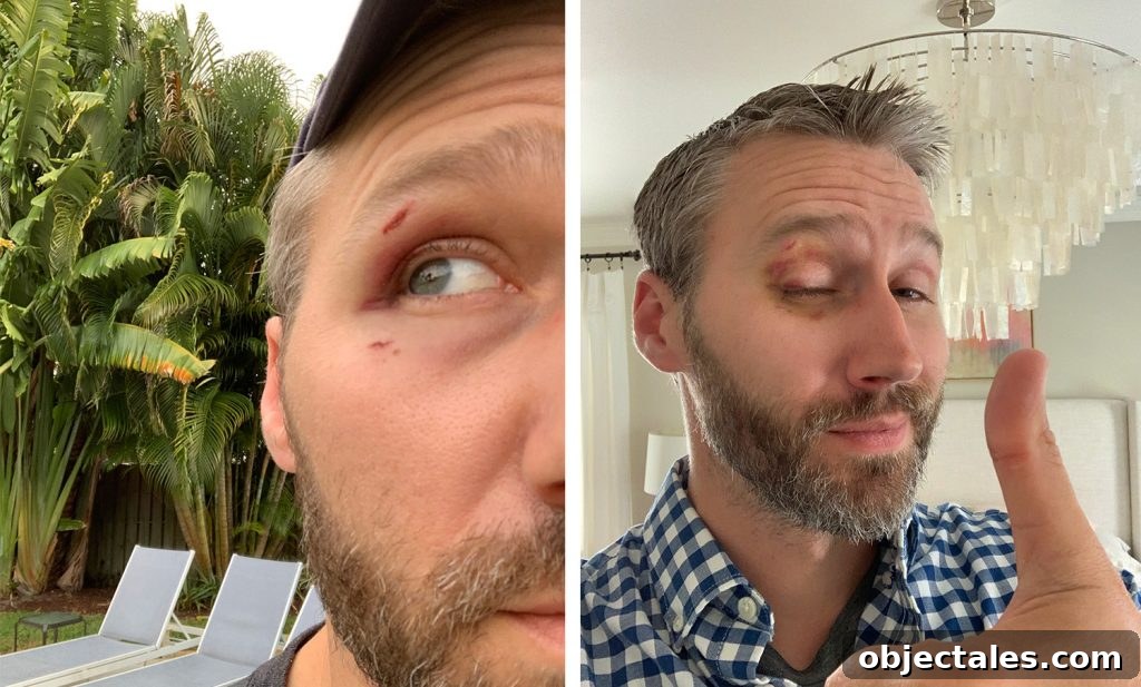 Bruising after closet incident